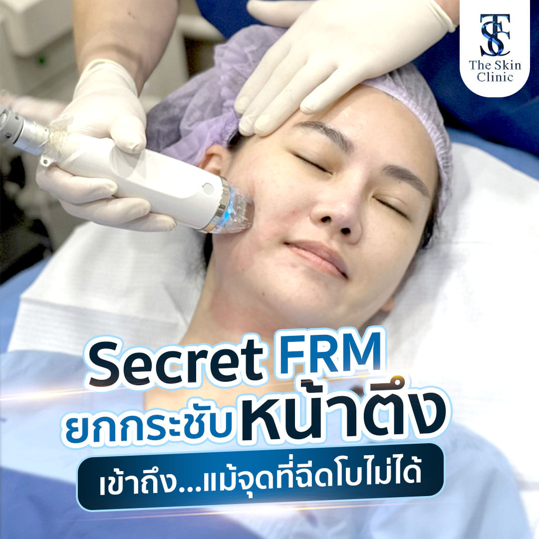 Secret FRM 