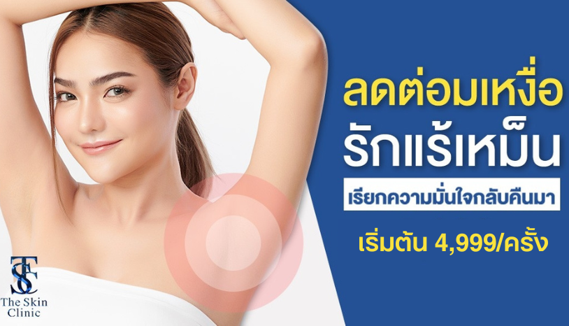 โปรโมชั่นเลเซอร์ระงับต่อมเหงื่อ